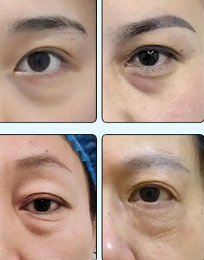 去眼袋手术