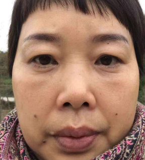 去眼袋手术