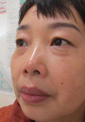 去眼袋手术