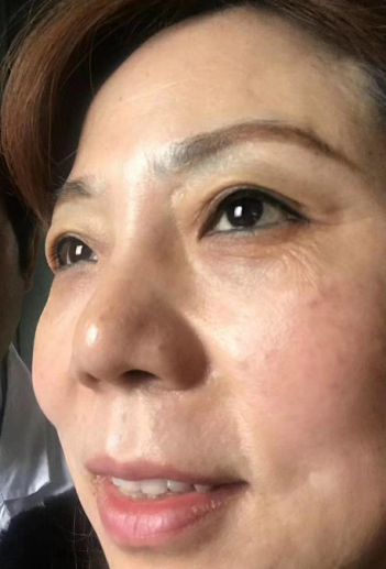 去眼袋手术