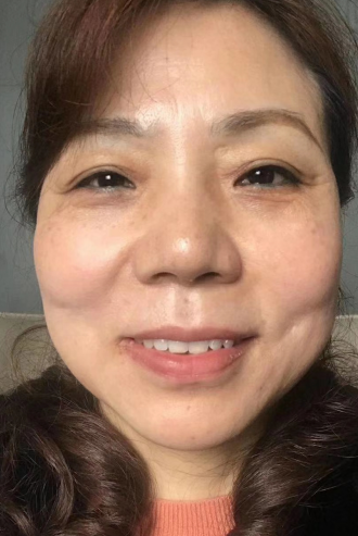 去眼袋手术