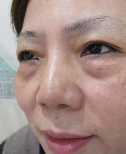 去眼袋手术