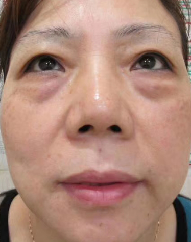 去眼袋手术