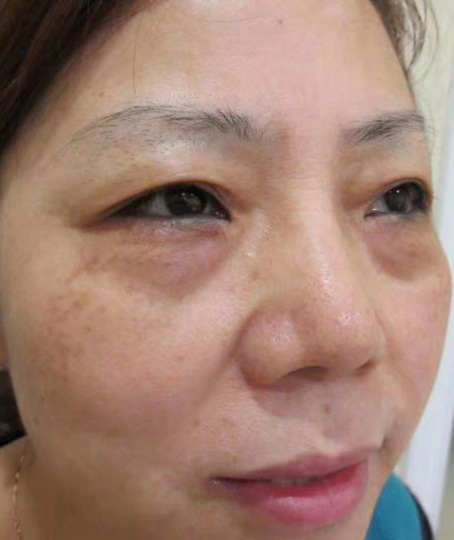 去眼袋手术