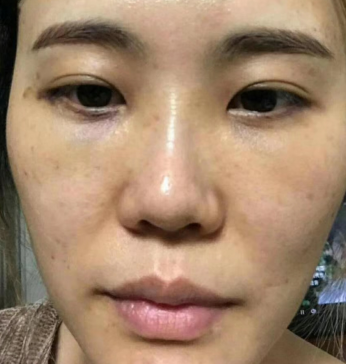 去眼袋手术