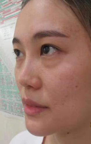 去眼袋手术