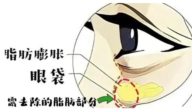 去眼袋手术