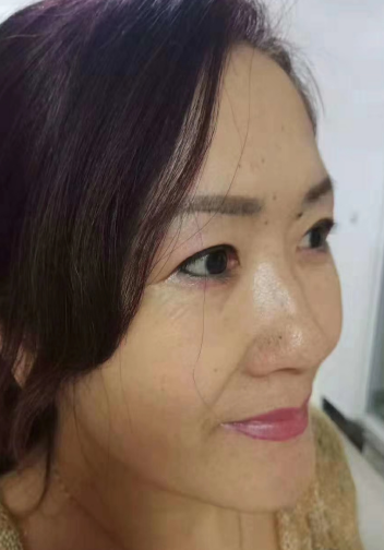去眼袋手术