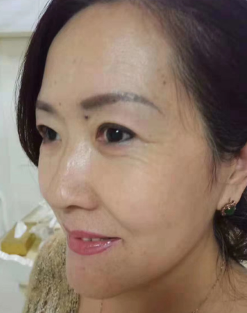 去眼袋手术