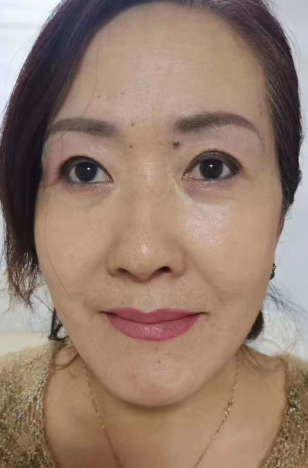 去眼袋手术