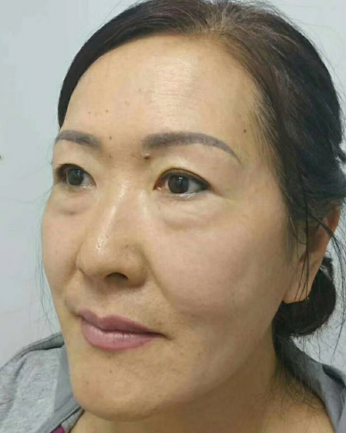 去眼袋手术