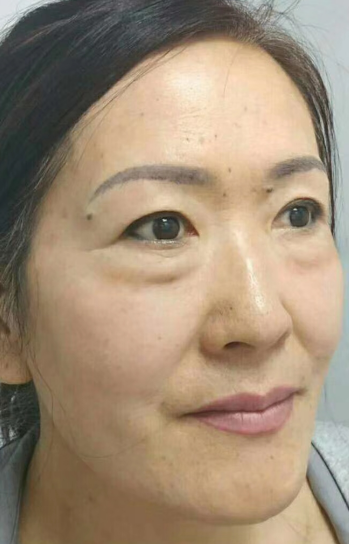 去眼袋手术
