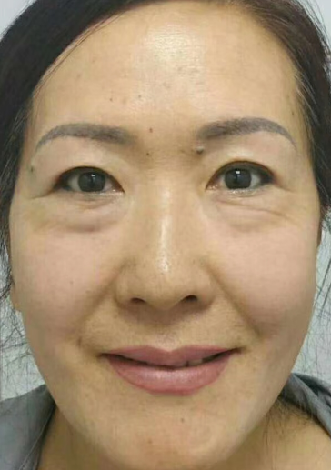 去眼袋手术