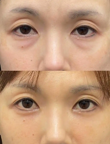 去眼袋手术