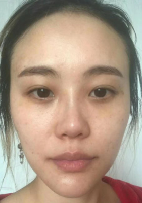 去眼袋手术