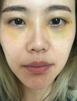 去眼袋手术