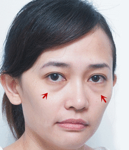 去眼袋手术