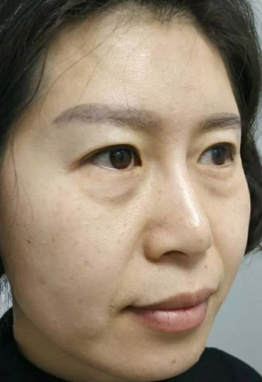 去眼袋手术