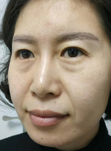 去眼袋手术
