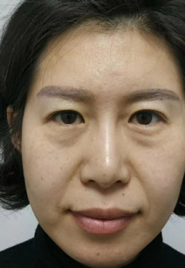 去眼袋手术