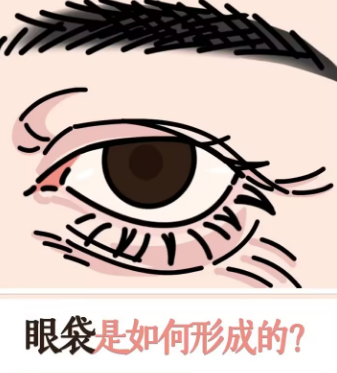 去眼袋手术