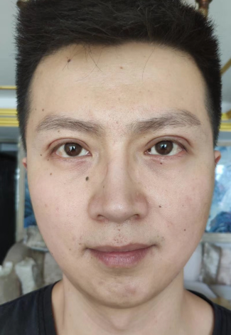 去眼袋手术
