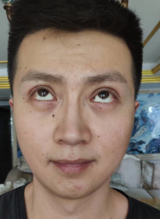 去眼袋手术
