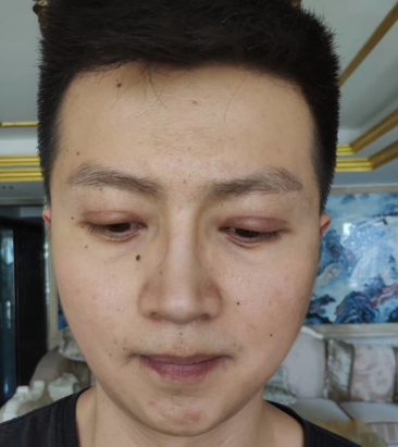 去眼袋手术