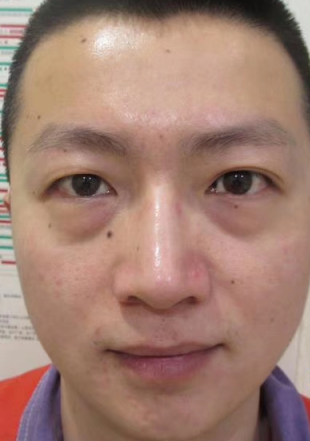 去眼袋手术