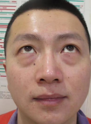去眼袋手术