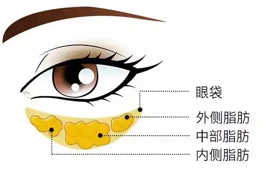 去眼袋手术