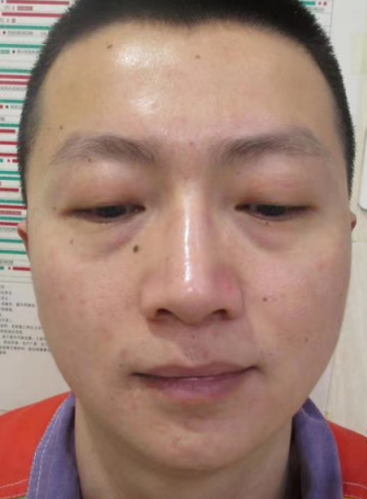 去眼袋手术