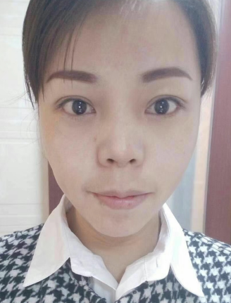 去眼袋手术