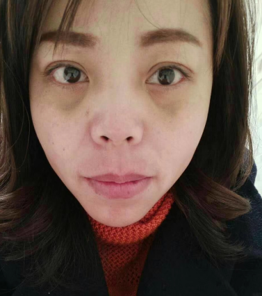 去眼袋手术