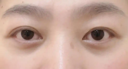 去眼袋手术