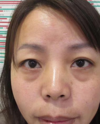 去眼袋手术