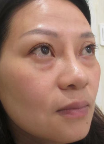 去眼袋手术