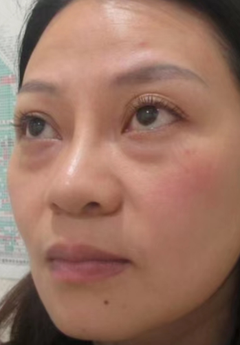 去眼袋手术