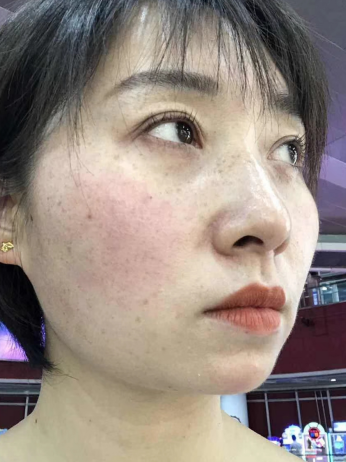 眼袋