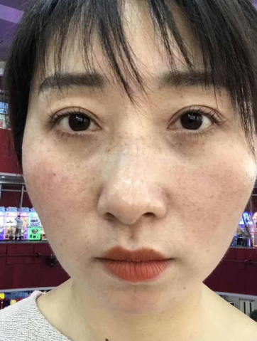 眼袋