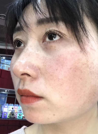 眼袋