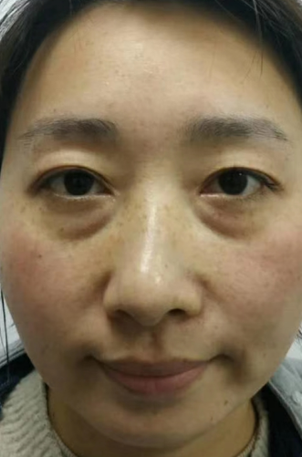 眼袋