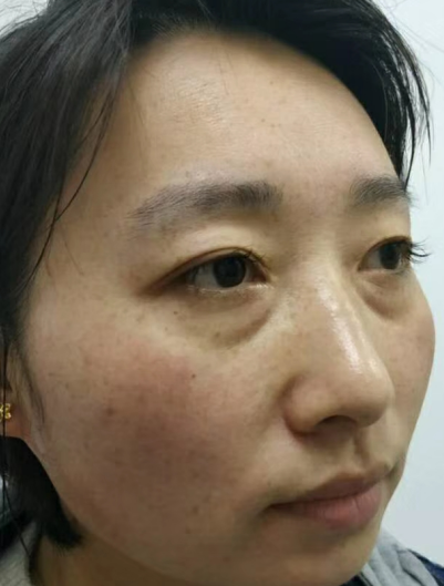 眼袋