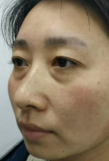 眼袋
