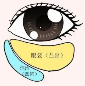 去眼袋手术
