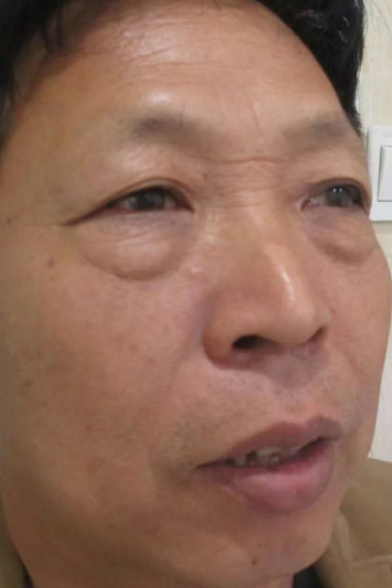 去眼袋手术