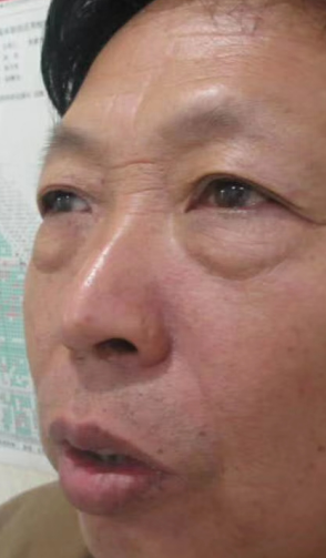 去眼袋手术