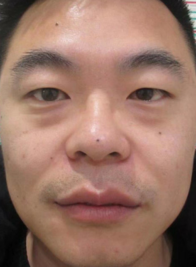 去眼袋手术