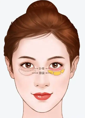 去眼袋手术