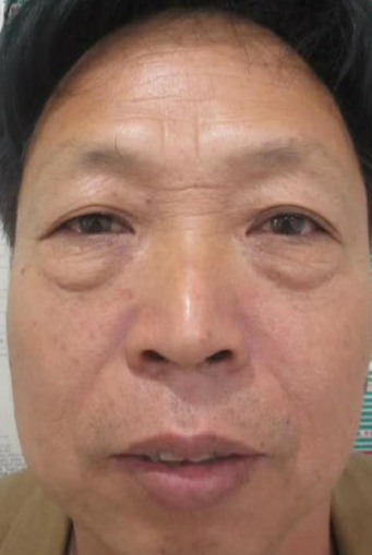 去眼袋手术